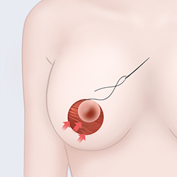 乳晕周围切割3
