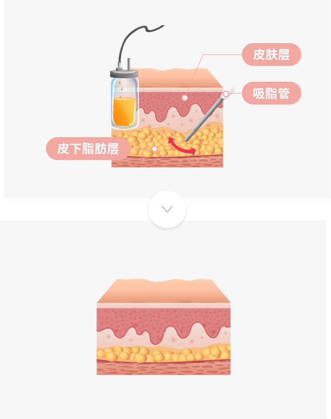 脂肪抽吸术是什么